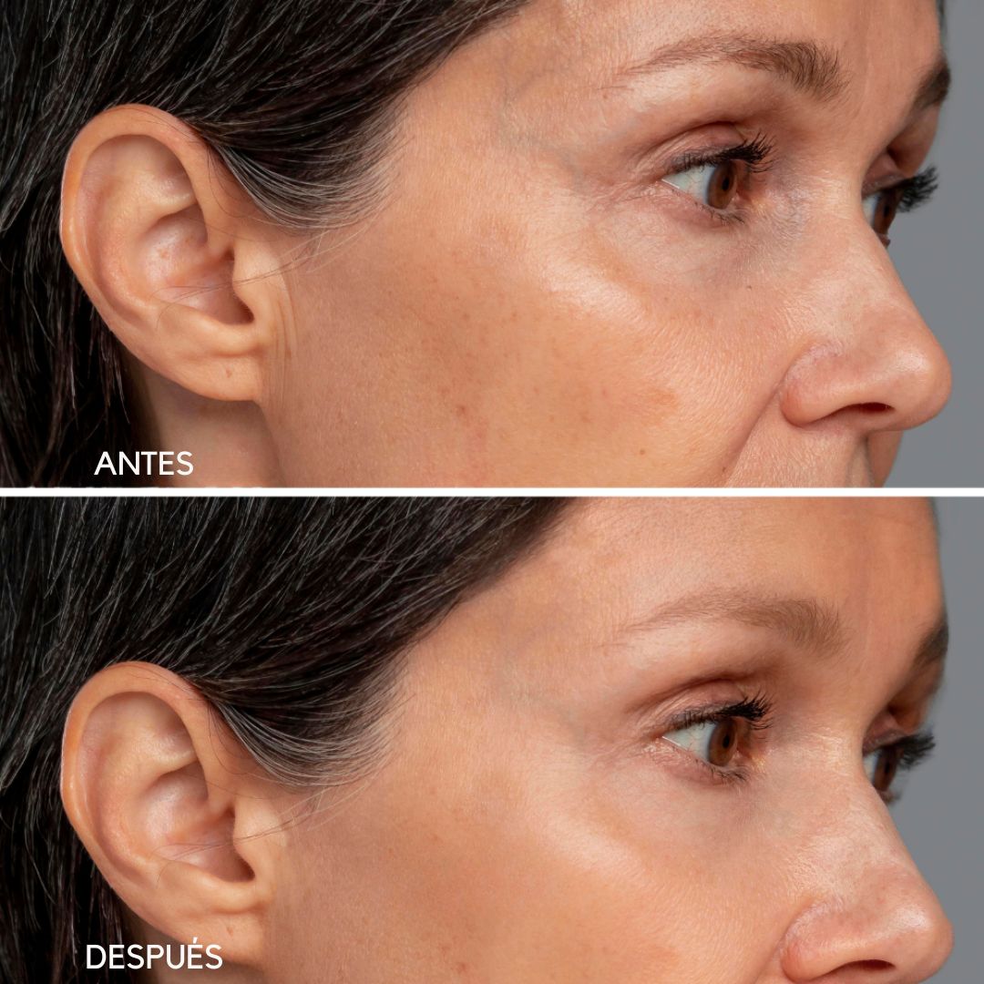 Dermalift - Masajeador Facial Antiarrugas
